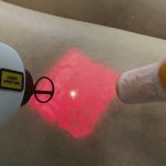 LASER para microvarizes e vasinhos