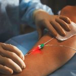 Cirurgia de varizes com LASER